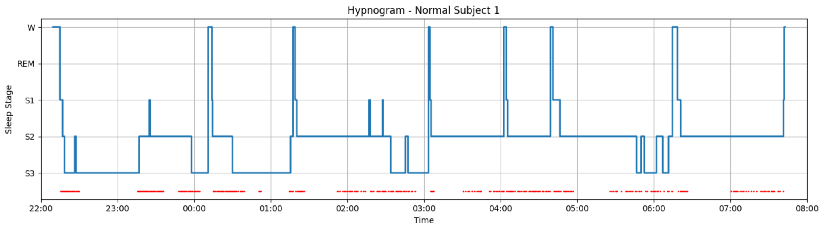 Hypnogram for Normal Subject